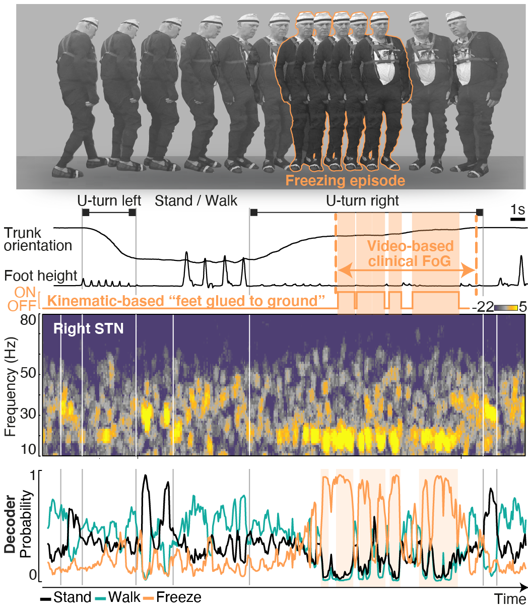 A freezing episode, with kinematics, subthalamic activity, muscle activity and the decoder tracking stand, walk and freeze